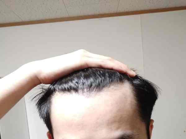 Tướng trán chữ M đàn ông có ý nghĩa gì