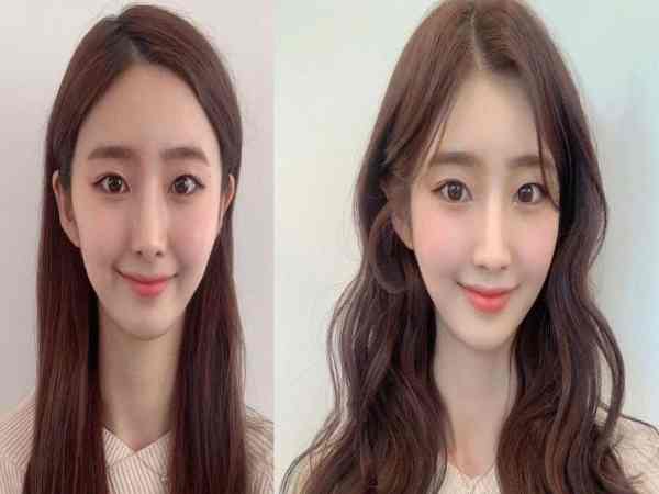 Tướng trán dô ở nam nữ thế nào?