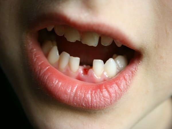 Nằm mơ bị gãy răng cửa là điềm gì, có con gì may mắn?